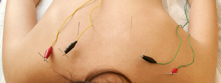 Dry needling with electrical stimulation side effects